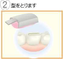 型をとります