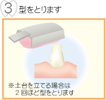 型をとります