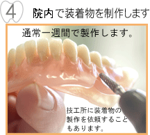 院内で装着物を製作します